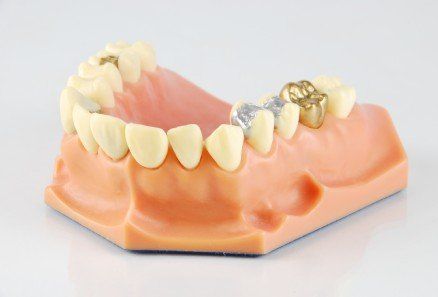 Dental model with upper and lower teeth, including gold and silver crowns on a pink gum base