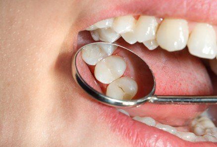 Close-up of a mouth with a dental mirror reflecting teeth and gums during an exam