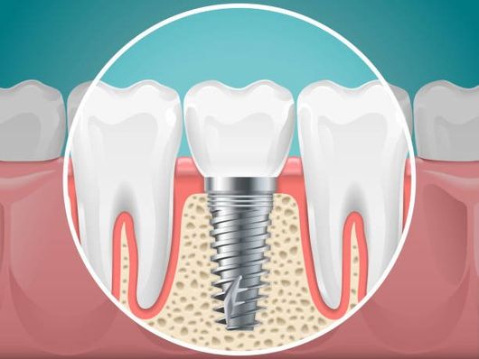 Illustration of a dental implant between white teeth and pink gums, with a curved white outline above.