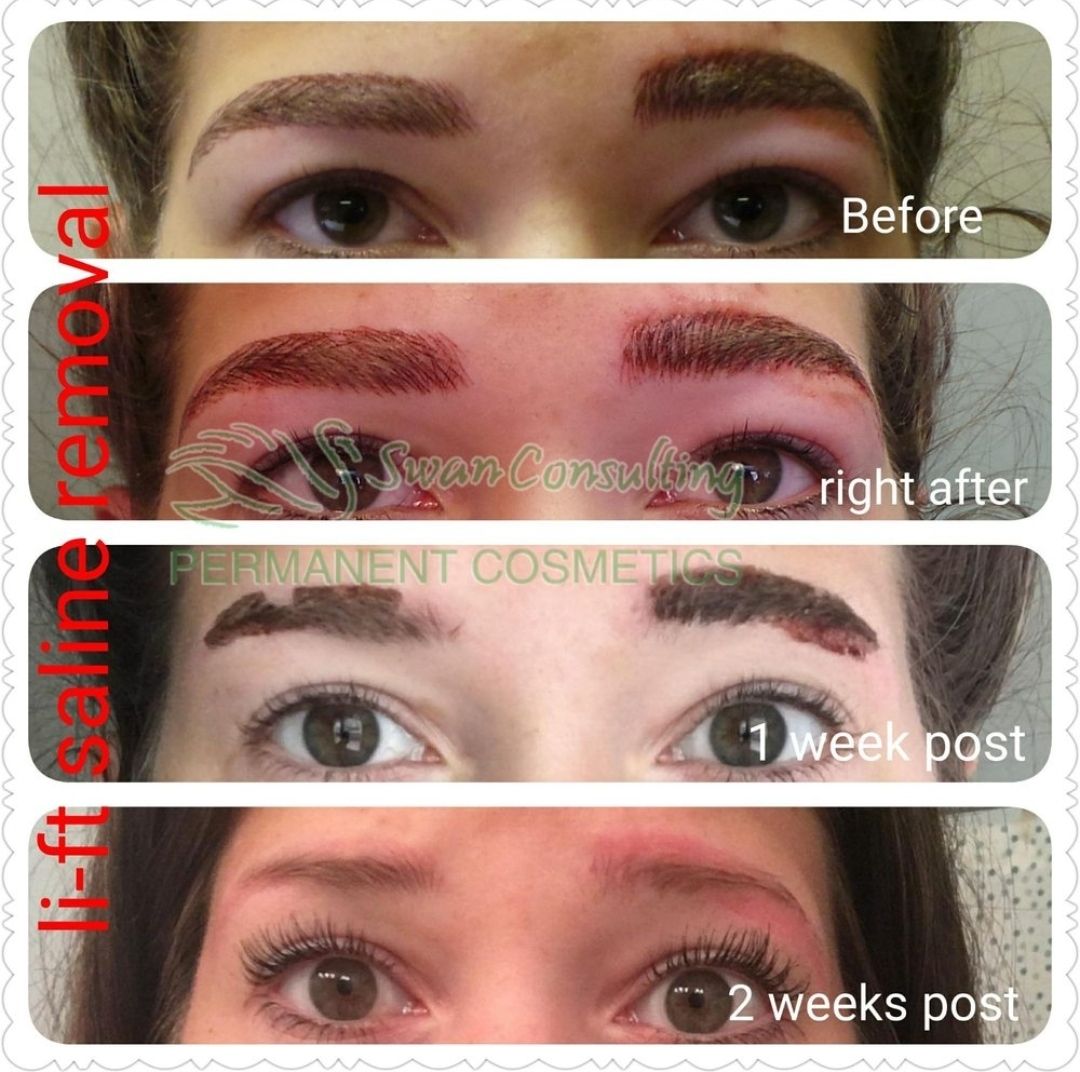 Before and after photos of eyebrow tattoo removal using saline and Li-ft methods. 