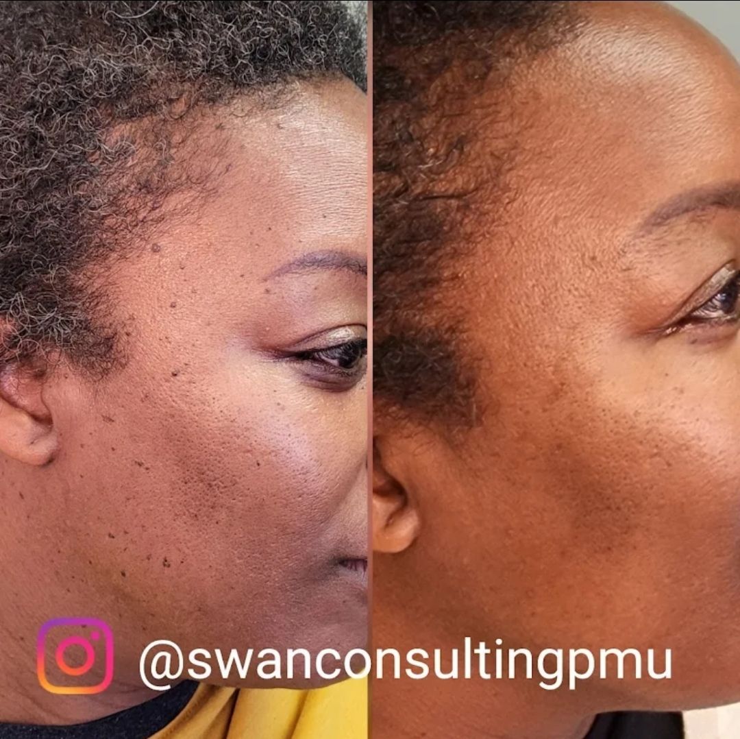 Before and after comparison of a person's face, showing an improvement in skin appearance after cosmetic treatment. 