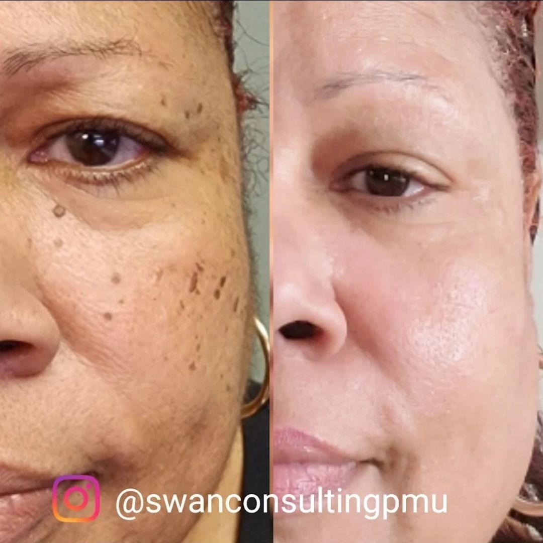 Before and after photos of a person's face, showing reduction in brown spots 