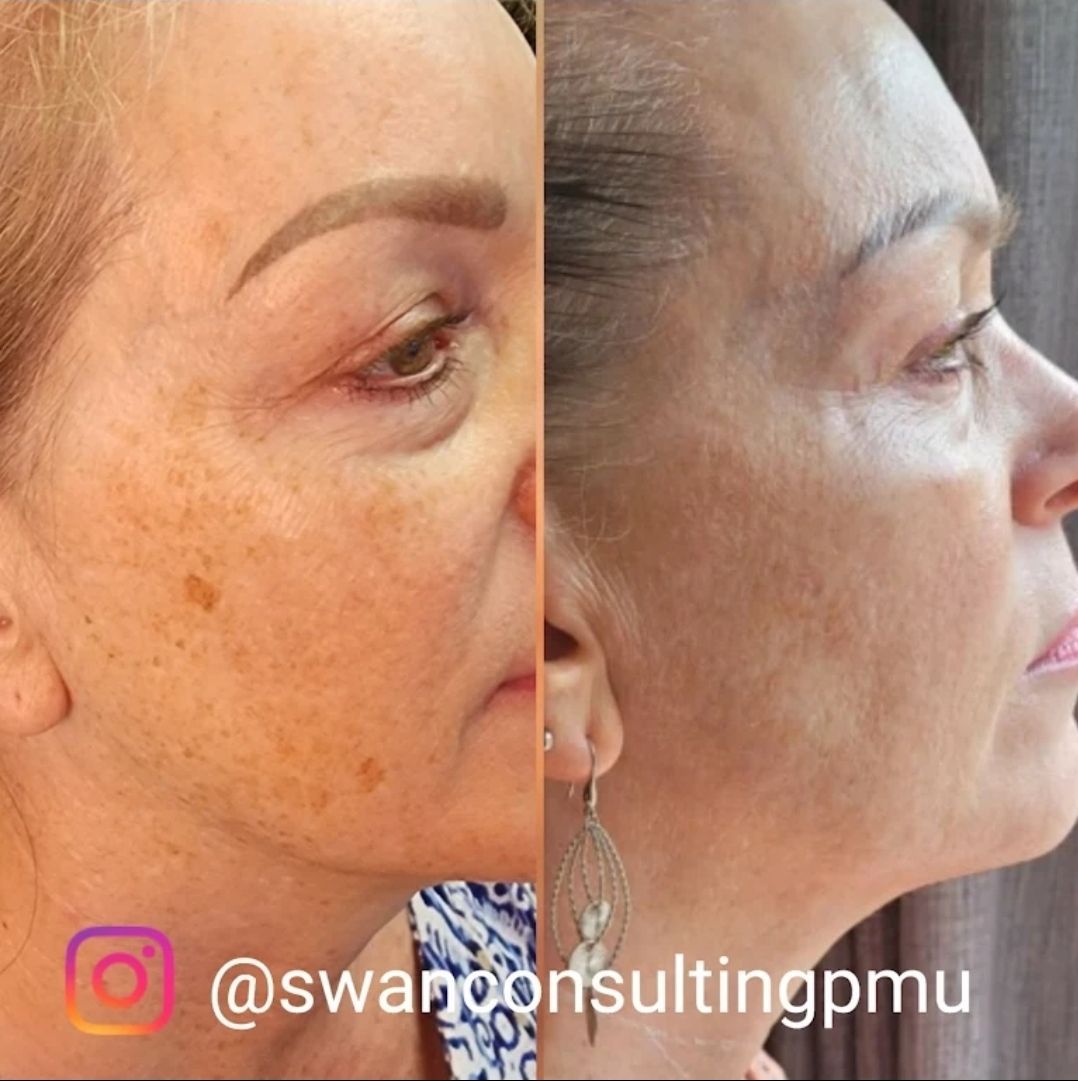 Side-by-side comparison showing a woman's face before and after a cosmetic procedure. 
