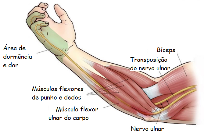 Compressão do nervo ulnar ou síndrome do túnel cubital