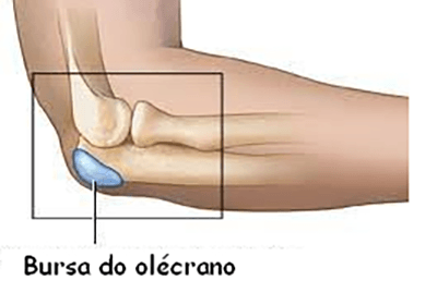 Um diagrama do cotovelo de uma pessoa mostrando a localização da bursa do olécrano.