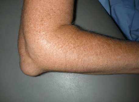 Um close do cotovelo de uma pessoa com uma grande protuberância.