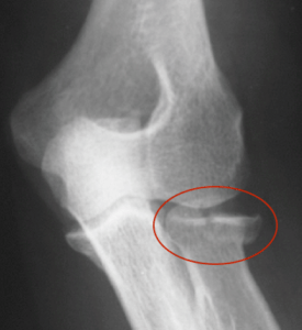 Uma radiografia de um cotovelo com um círculo vermelho ao redor