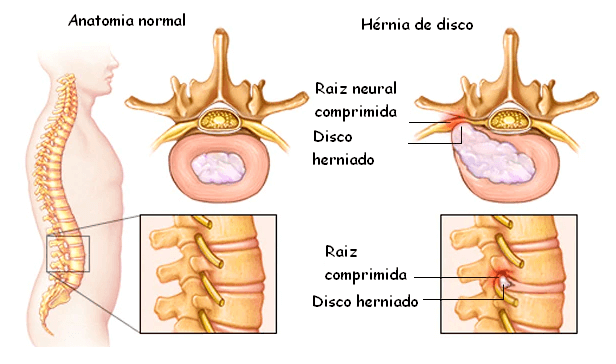 Um diagrama de uma coluna normal e uma hérnia de disco
