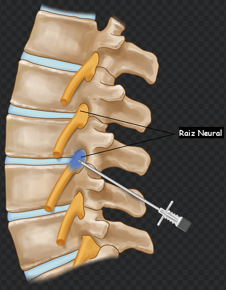 Um diagrama de uma coluna vertebral mostrando a raiz neural