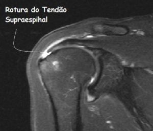 Uma imagem em preto e branco de um ombro com as palavras rotura do tendão supraespinal acima dele