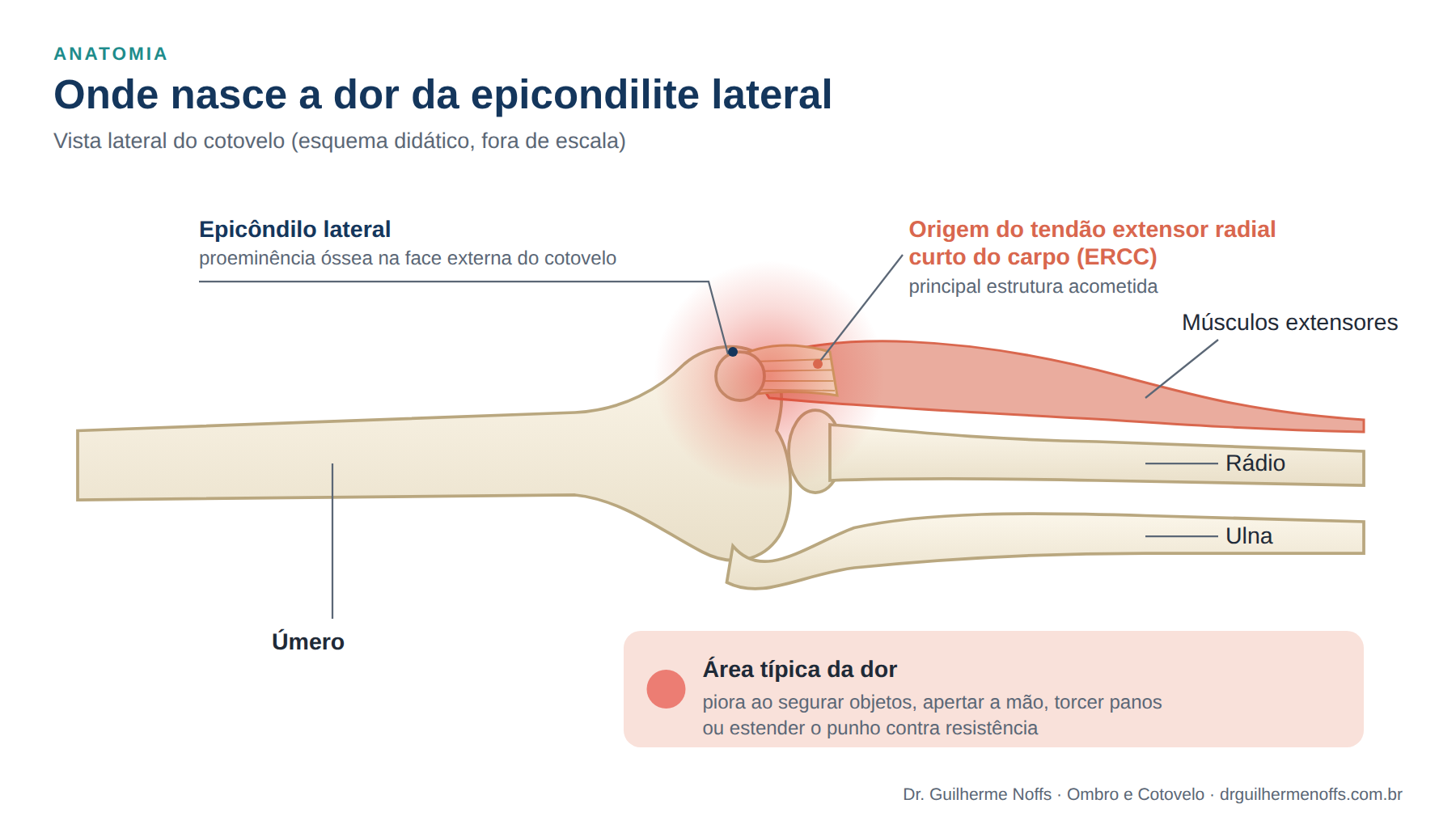 Figura 2. Anatomia da epicondilite lateral: a dor se concentra na origem do tendão extensor radial curto do carpo, junto ao epicôndilo lateral.

