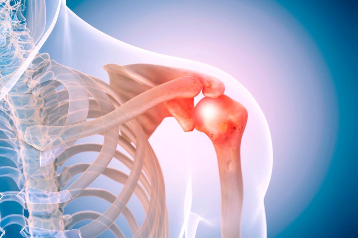 Pós operatório de cirurgia de prótese no ombro: o que esperar da recuperação?