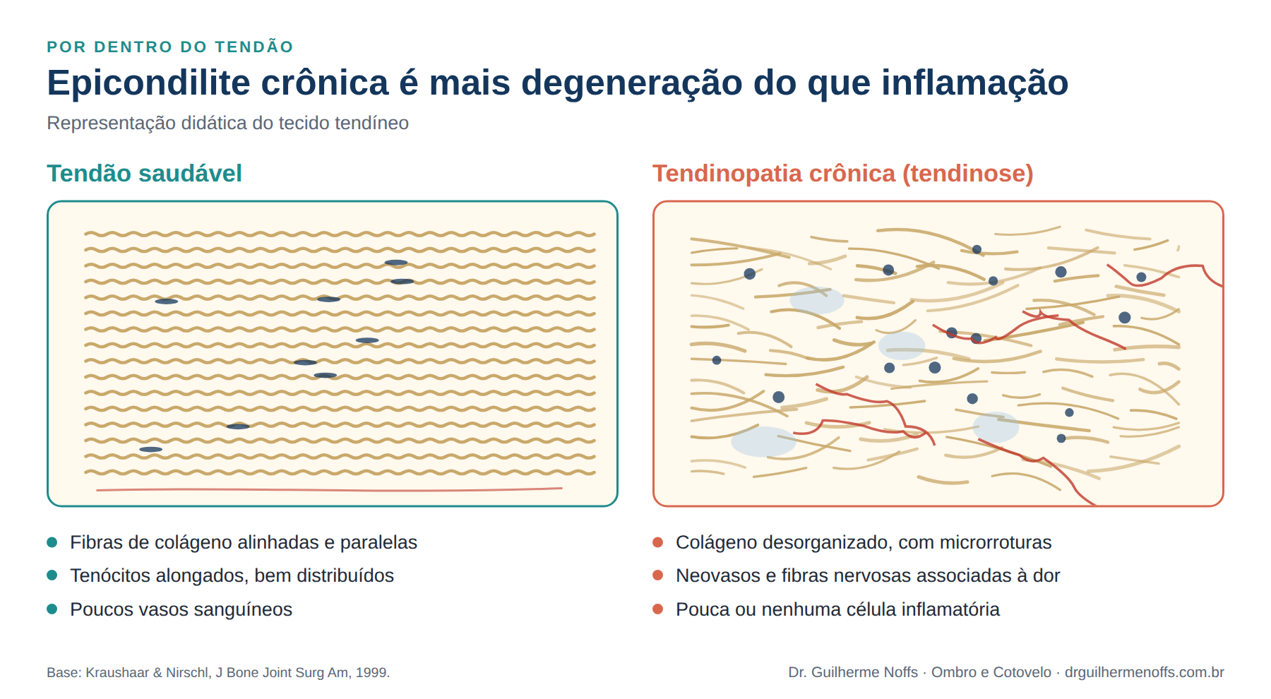 Figura 3. Tendão saudável x tendinopatia crônica: na epicondilite de longa duração, o problema é estrutural, não só inflamatório.
