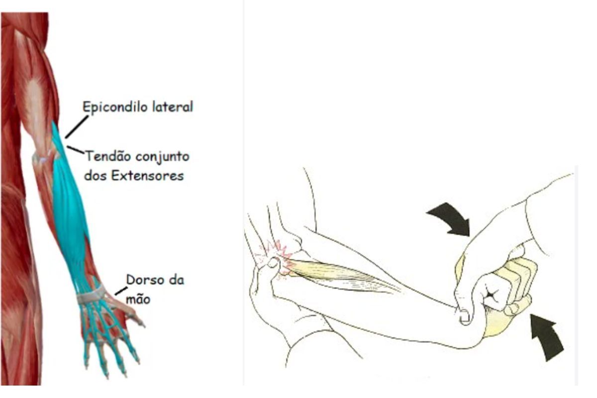 recidiva-epicondilite-guilherme-noffs-ortopedista-ombro-cotovelo-s%C3%A3o-paulo