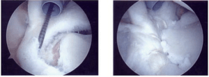 Uma radiografia do joelho de uma pessoa mostrando um buraco nele