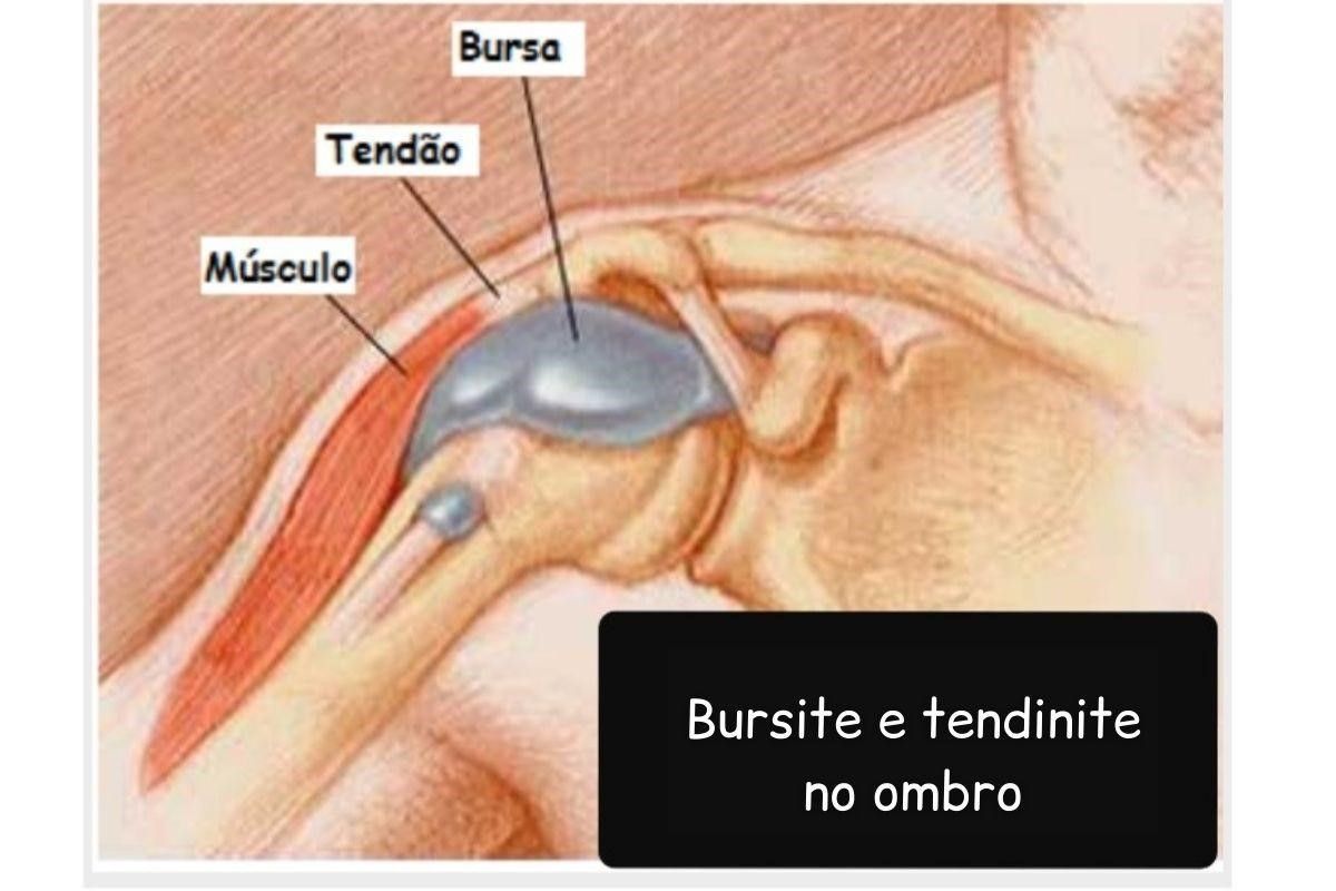 tendinite-e-bursite-no-ombro-entenda-a-rela-o-entre-essas-condi-es
