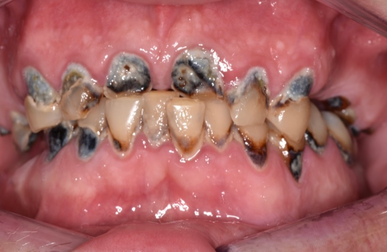 Close-up of severely decayed and discolored teeth with dark cavities and gum inflammation