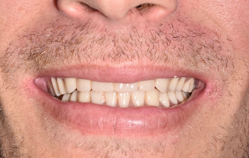 Close-up of a smiling mouth with visible teeth and light facial hair