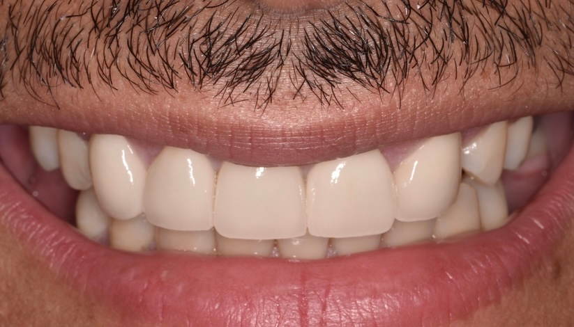 Close-up of a smiling mouth with white teeth and a trimmed mustache above the upper lip