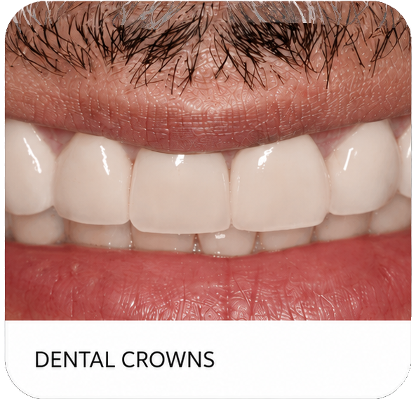 Close-up of bright white dental crowns on upper teeth with lips visible