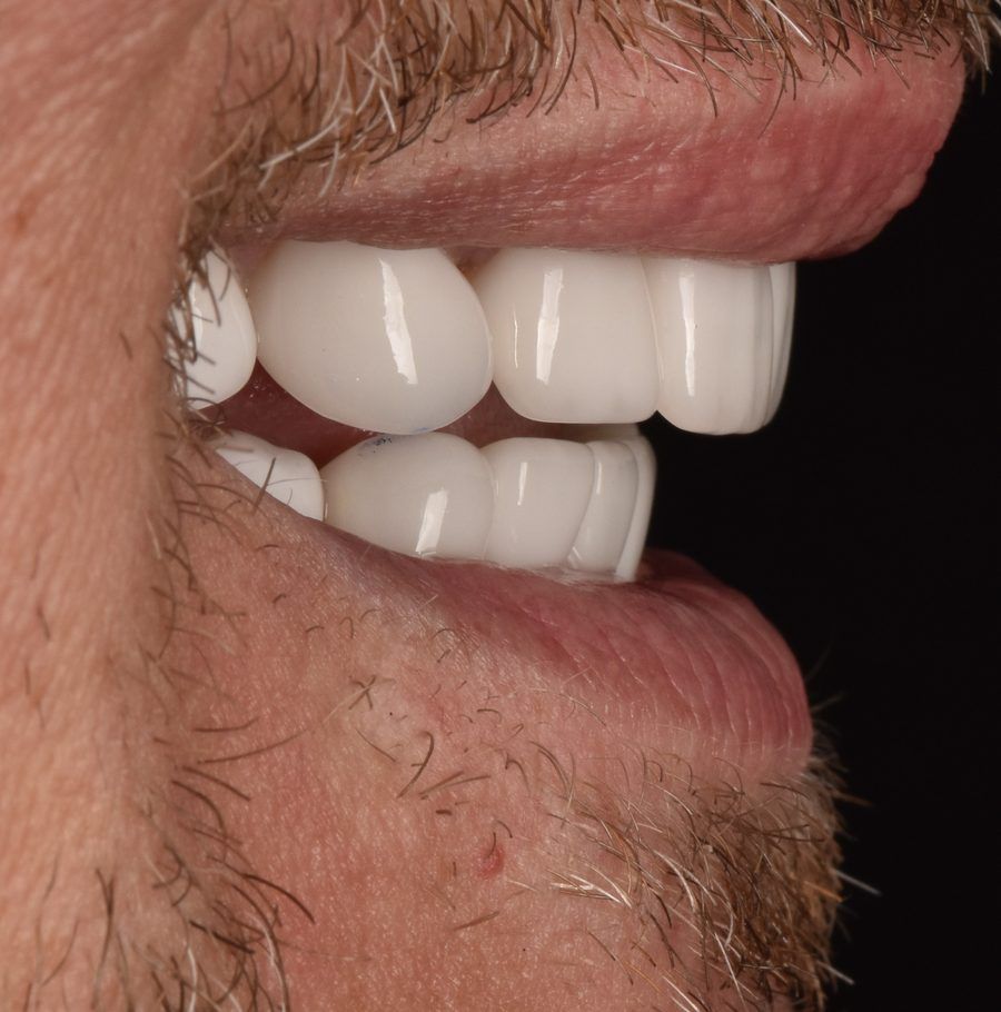 Close-up of a mouth showing white dental veneers in a side profile.
