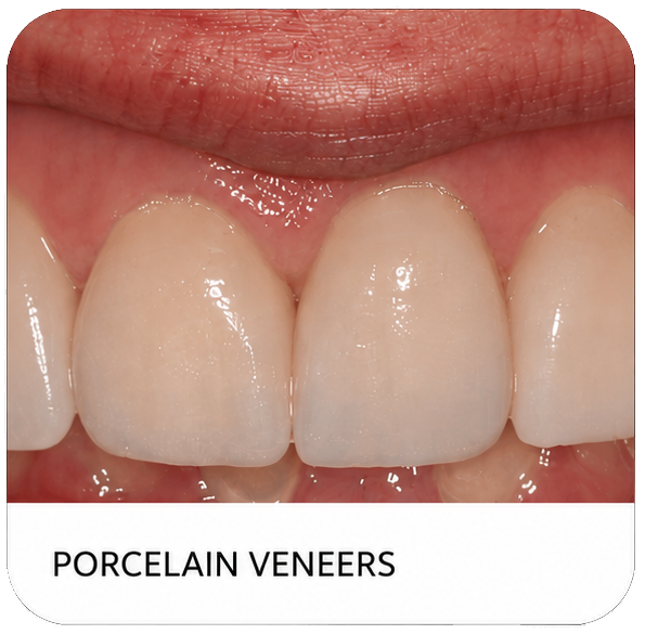 Close-up of lips and bright white porcelain veneers with glossy finish