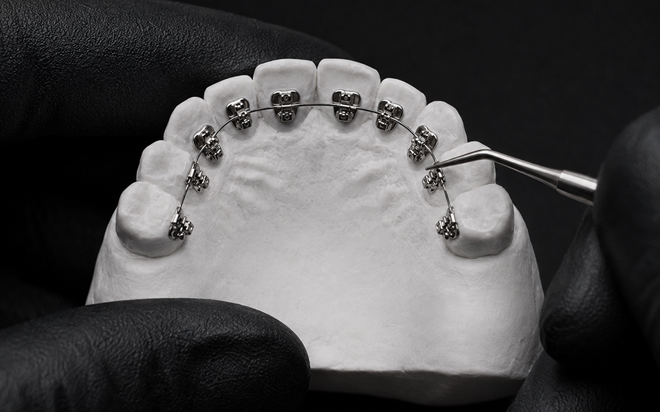 Lingual braces bonded to the inner surfaces of the teeth, Yonsei Baro Orthodontics, Seoul