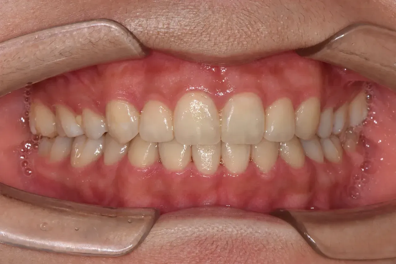 After braces treatment: the young patient’s teeth at the end of 18 months of active treatment, Yonsei Baro, Seoul