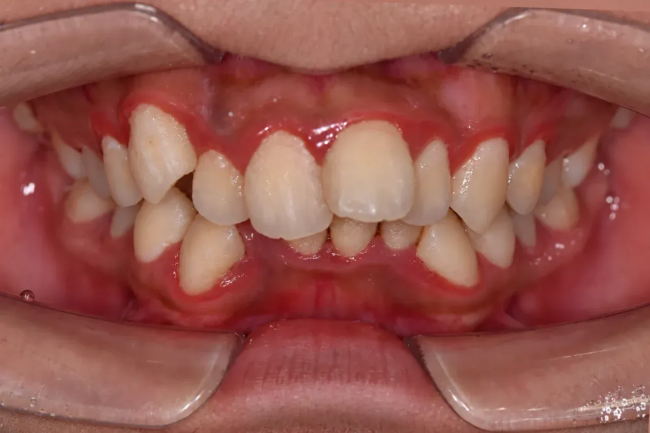 Before braces treatment: crowded teeth with canines erupted outside the arch and a deep overbite