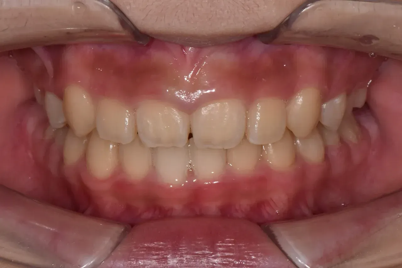 After non-extraction braces: the young patient’s teeth at the end of 19 months of active treatment, Yonsei Baro, Seoul