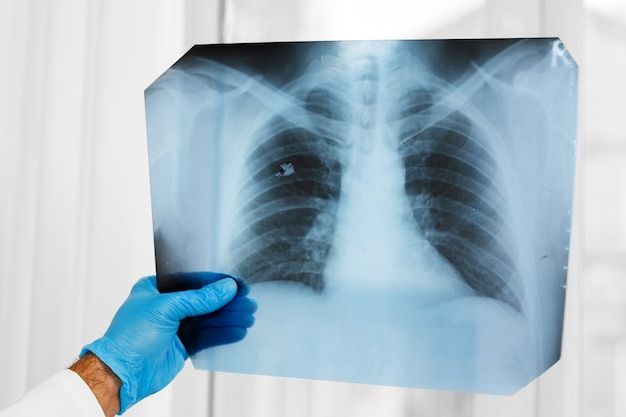 A person in blue surgical gloves holding an X-ray of a human chest, in front of a window.