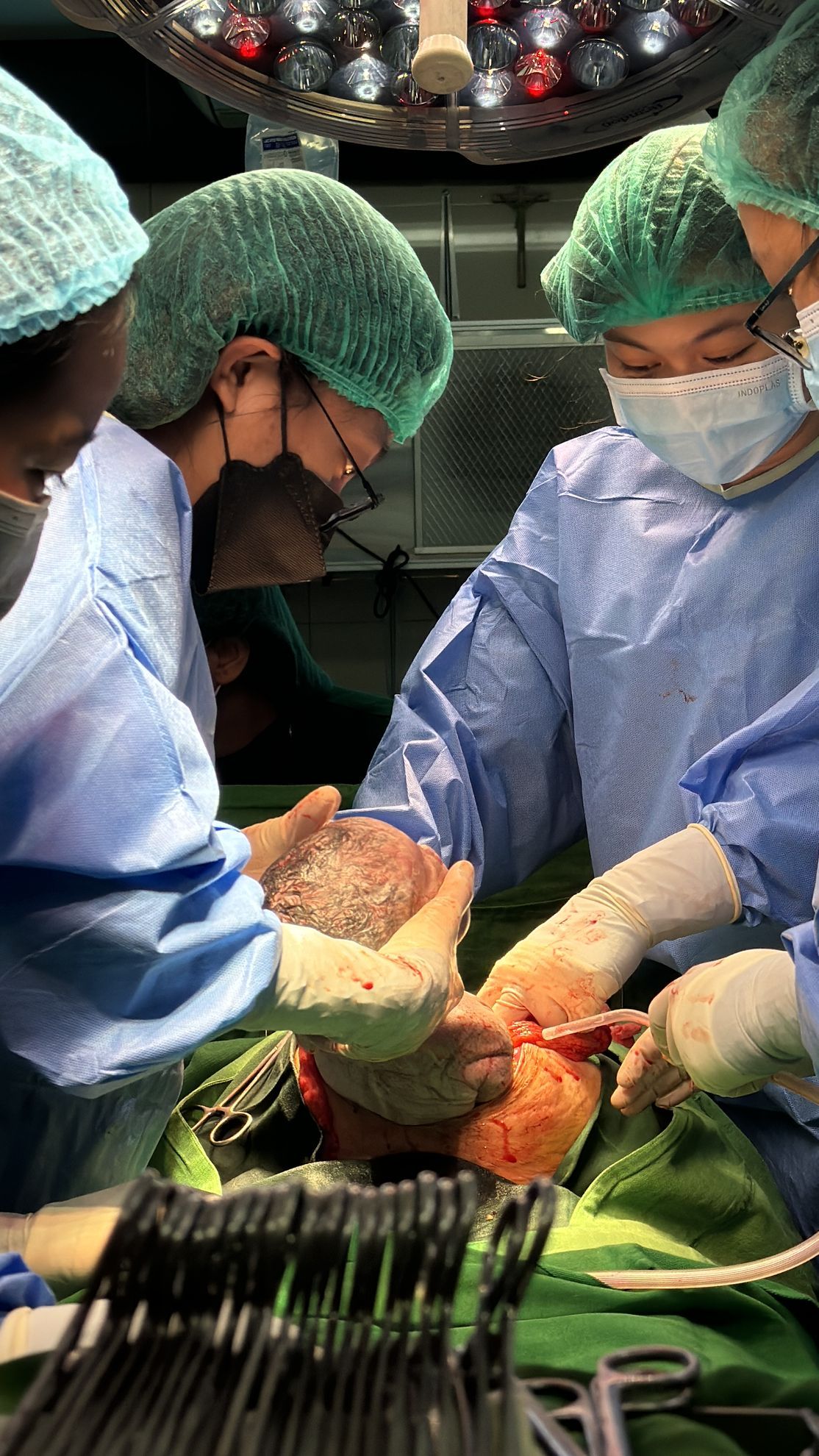 Medical team performing surgery, hands holding tissue, operating room setting.
