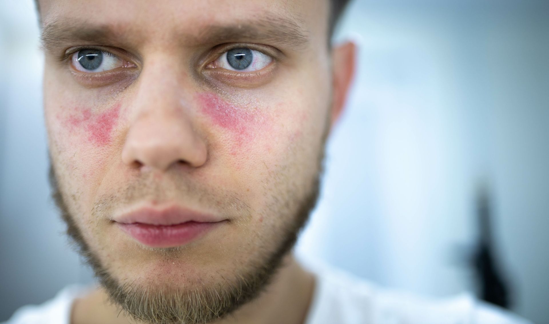 A man with a beard has red spots on his face.