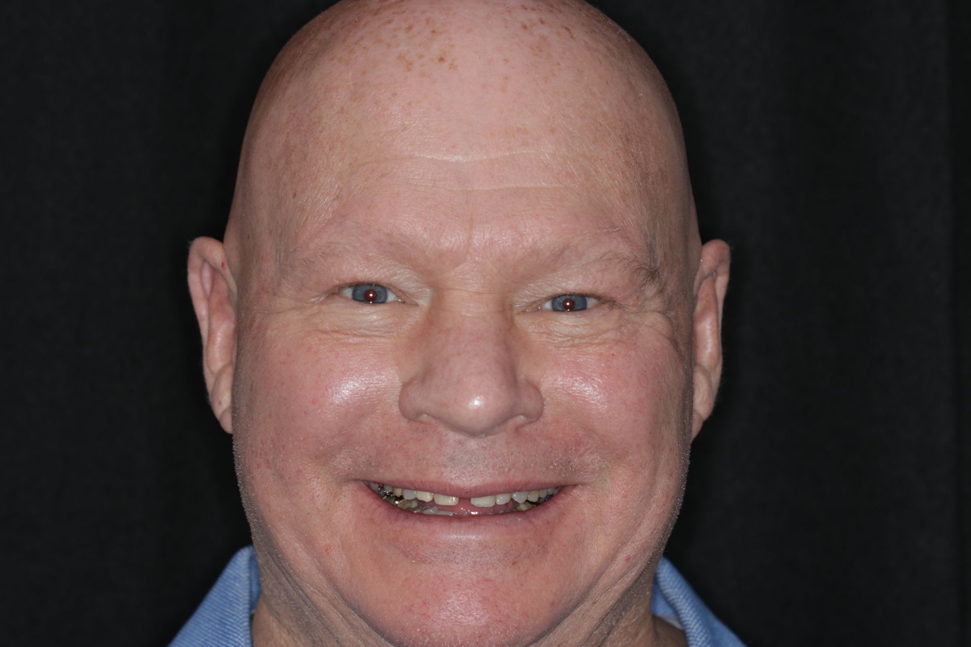 A bald man with braces on his teeth is smiling for the camera.