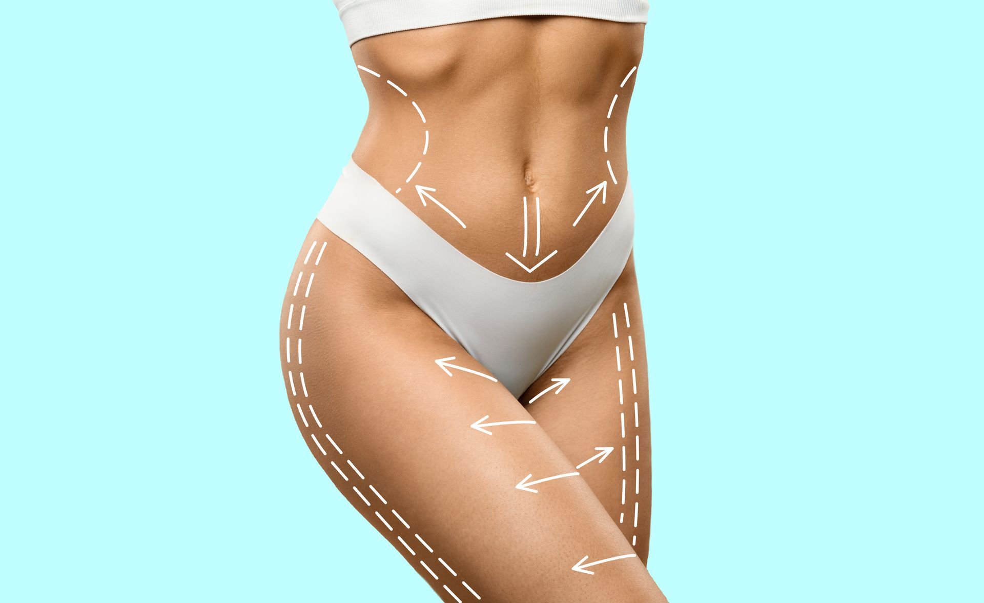 Woman's body with surgical markings for liposuction, against a light blue background.