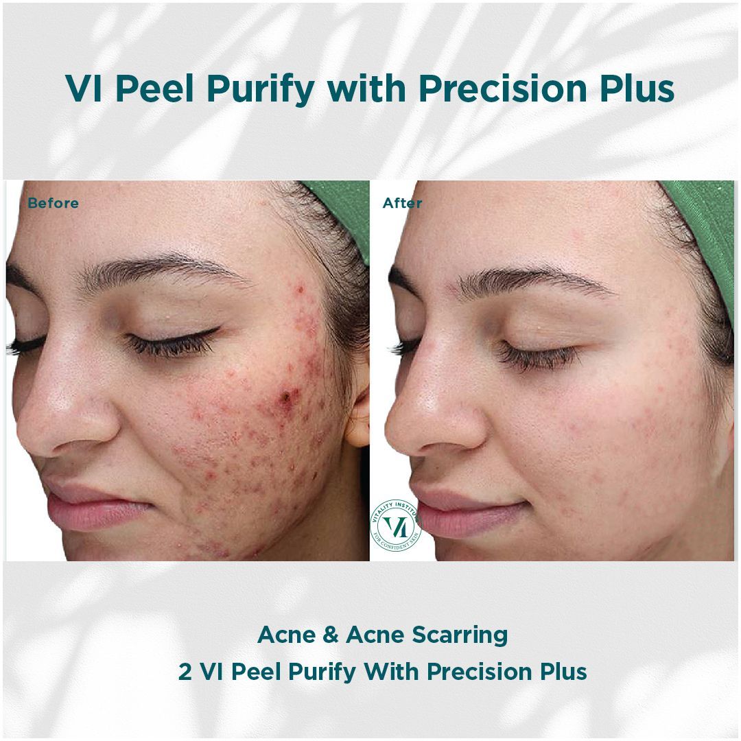 A before and after photo of a woman 's face with acne and scarring