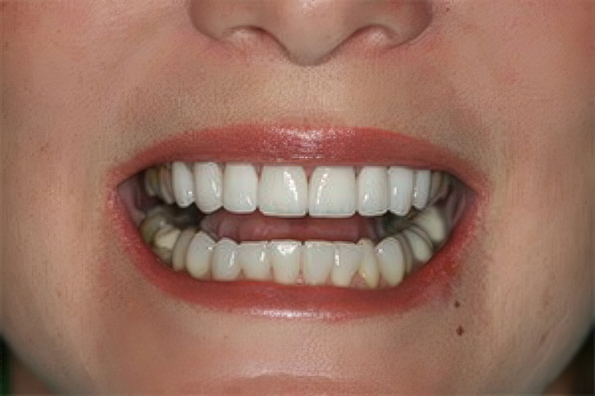 Close-up of a smiling mouth with white teeth and metallic braces