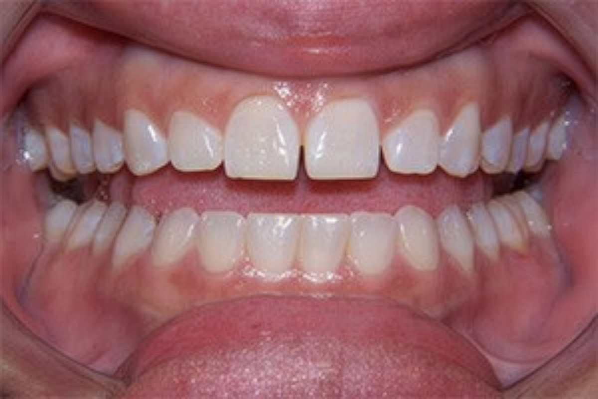 Close-up of a mouth showing upper and lower teeth with noticeable gaps and crowding