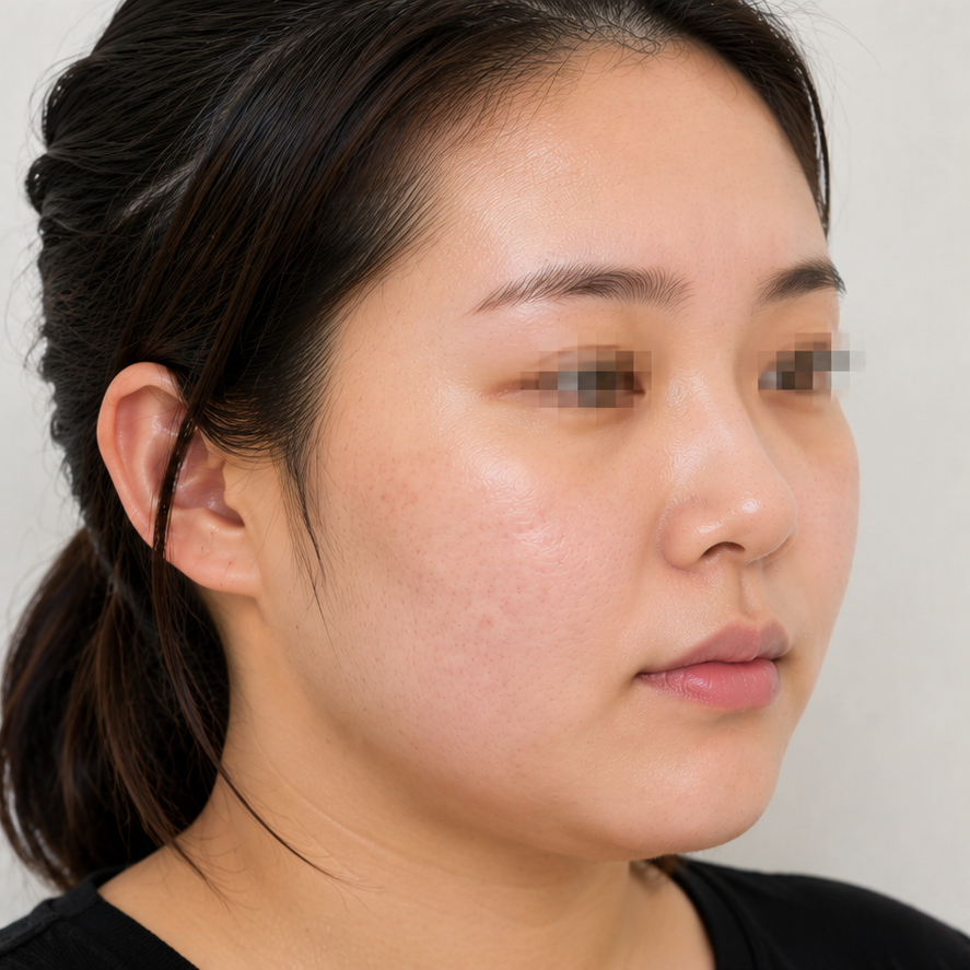 Same patient after acne scar laser at JRYN Busan