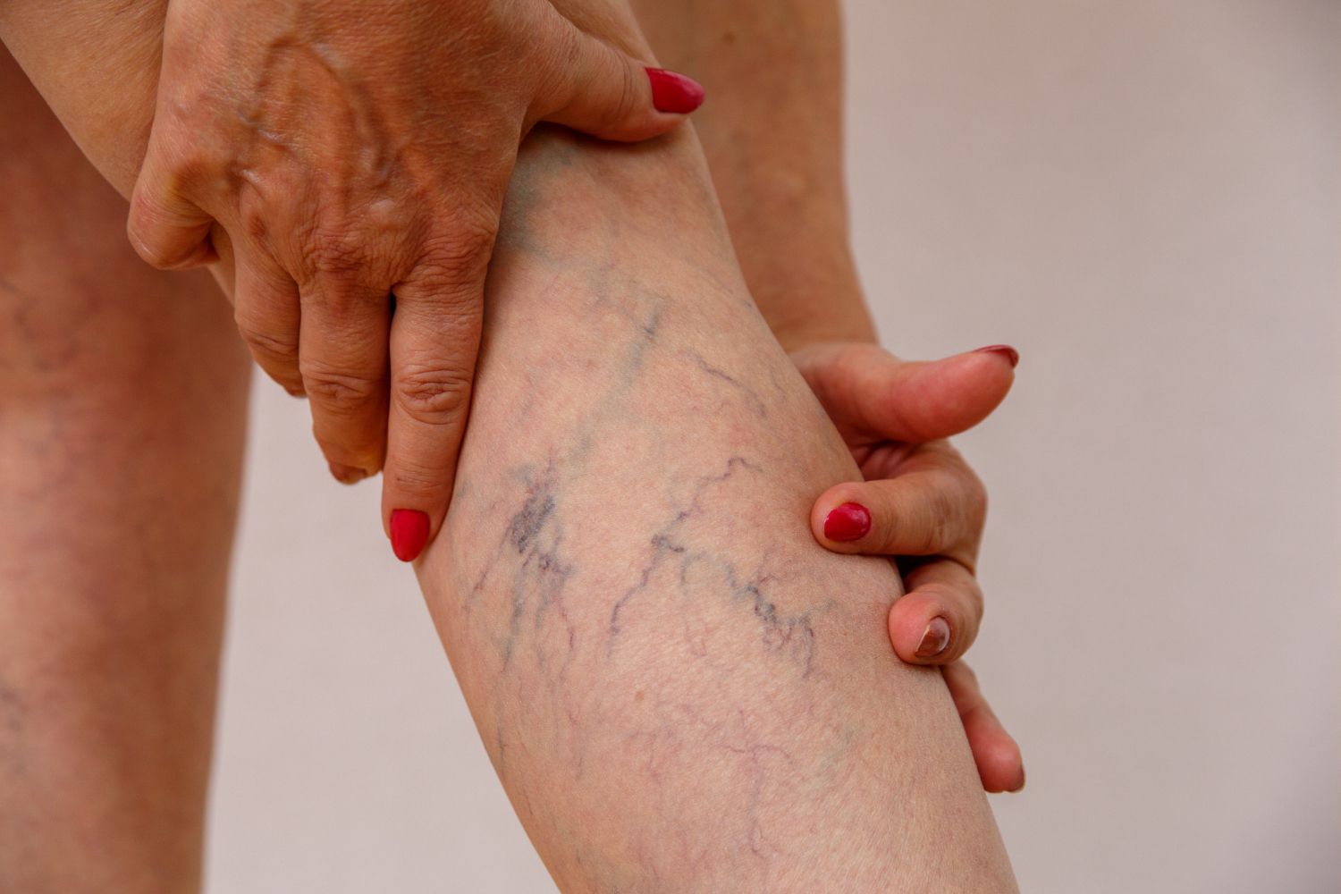 Hands holding a leg with visible spider veins and red nail polish