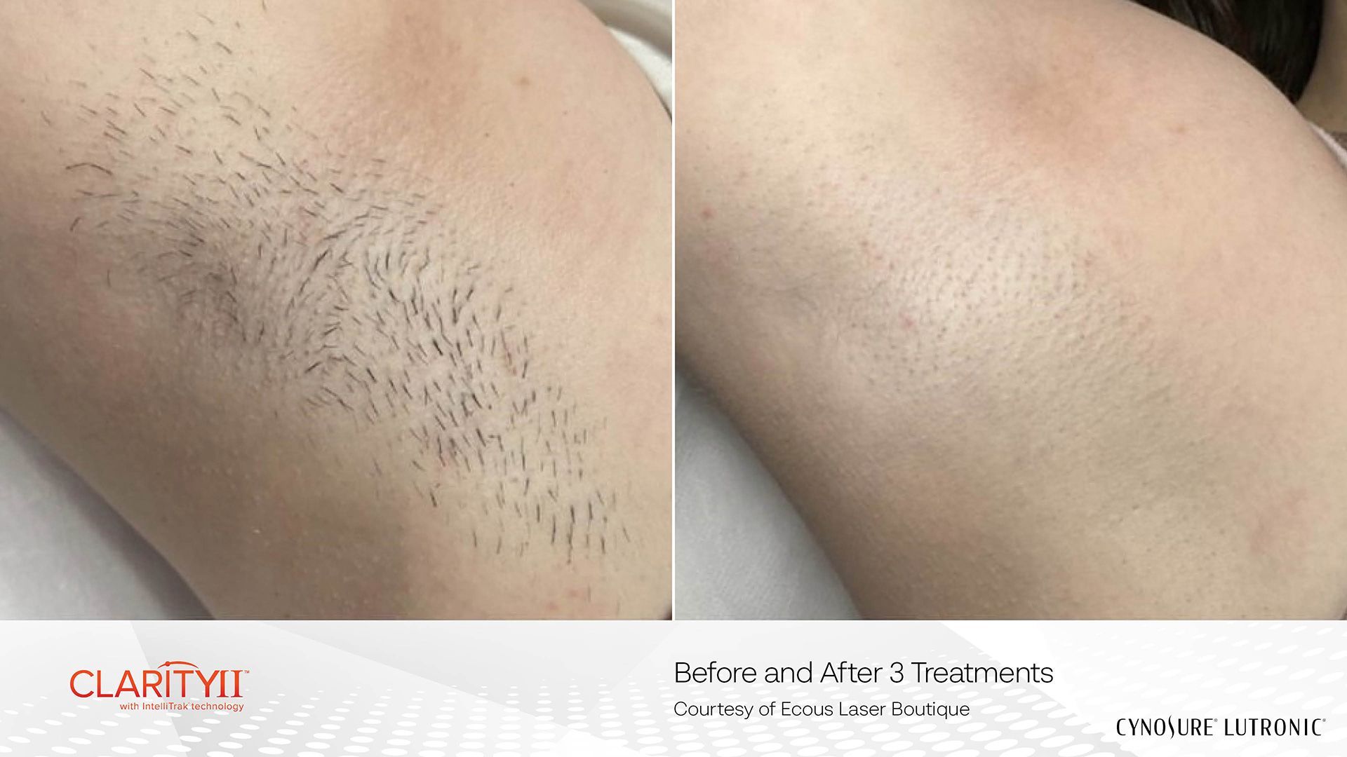 Close-up before-and-after of skin with hair stubble on the left and smoother skin on the right.