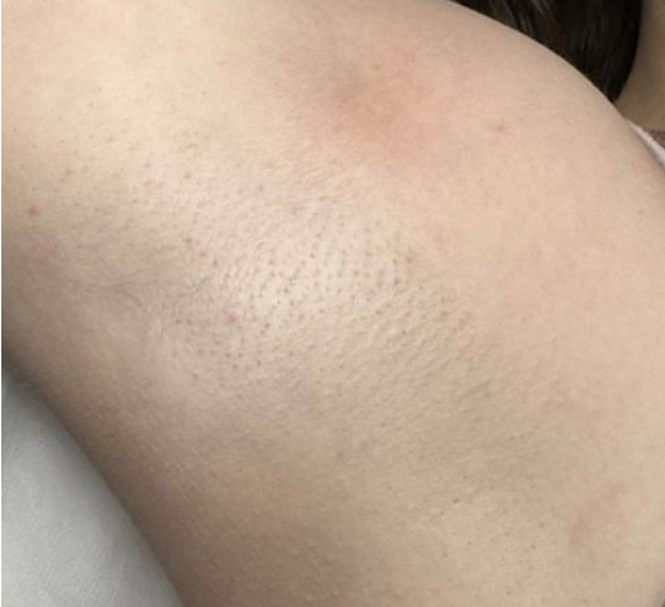 Before-and-after close-up of skin with reduced hair stubble, showing smoother legs or arm.