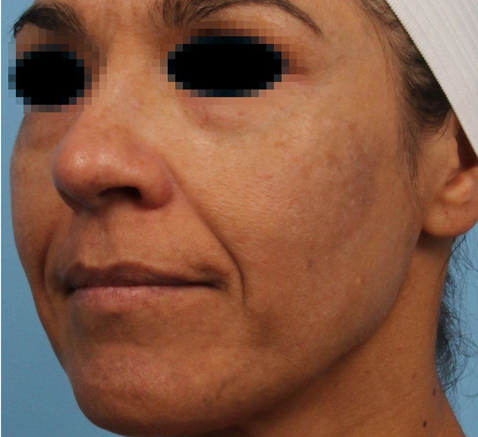 Side-by-side facial skin before-and-after comparison showing reduced dark spots and smoother skin focus