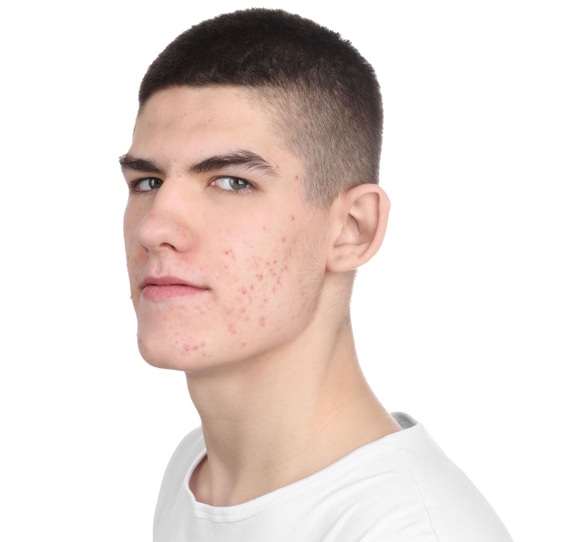 Close-up portrait of a young man with short dark hair, neutral expression, and acne on his cheek.