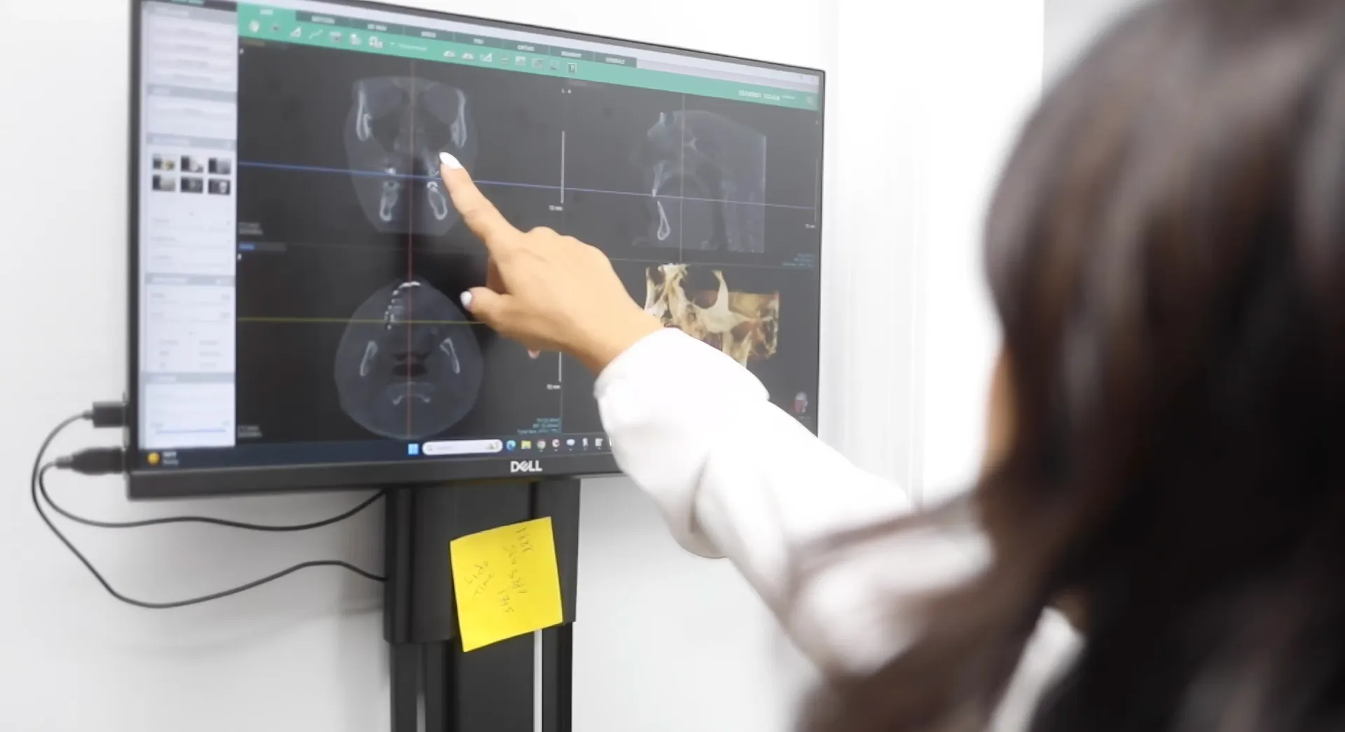 A woman is pointing at an x-ray on a computer screen. - dental implants