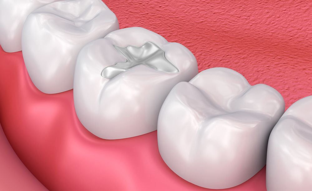 A close up of a tooth with a filling in it.