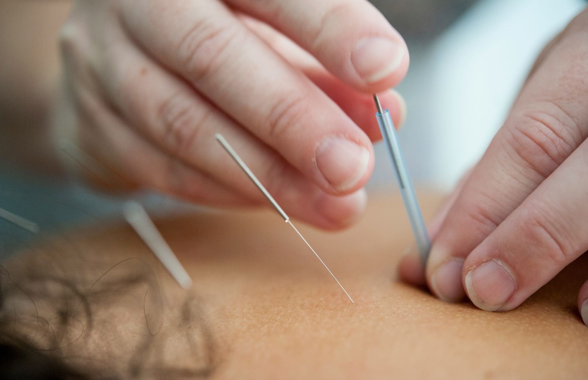 A person is getting acupuncture on their back.