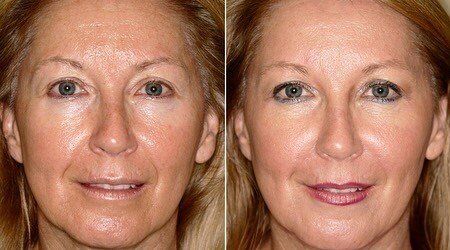 Dual injector pro Skin tightening