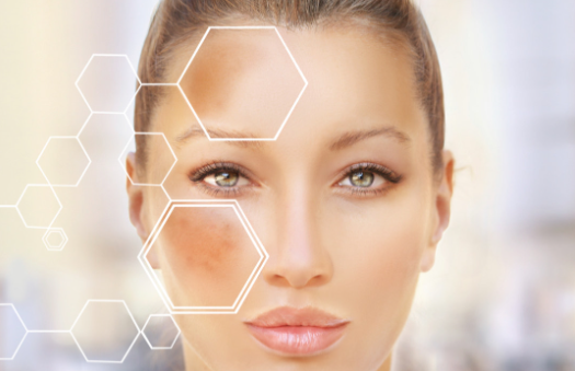 Pigmentation removal