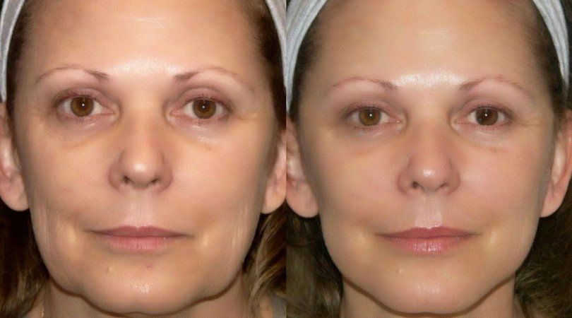 Dual injector pro Skin tightening